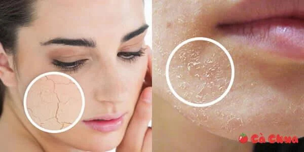 Biểu hiện của da thiếu ẩm Khái niệm dưỡng ẩm cho da